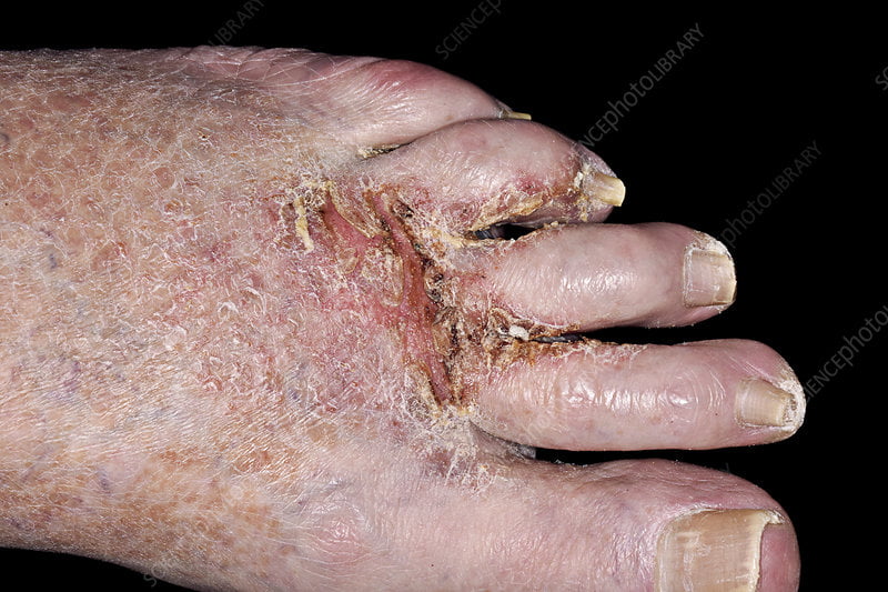 Not to be used for advertising or in a defamatory context
Ringworm and secondary bacterial infection of the foot. This is a case of a chronic fungal skin infection on the left foot of an 80-year-old man. Known as ringworm, and also called athlete's foot or tinea pedis, this is a dermatophyte infection caused by a fungus. It is highly contagious and is spread by direct contact or via infected material. It is treated by application of an antifungal agent. Secondary bacterial infections occur following an initial infection, and are treated with antibiotics.