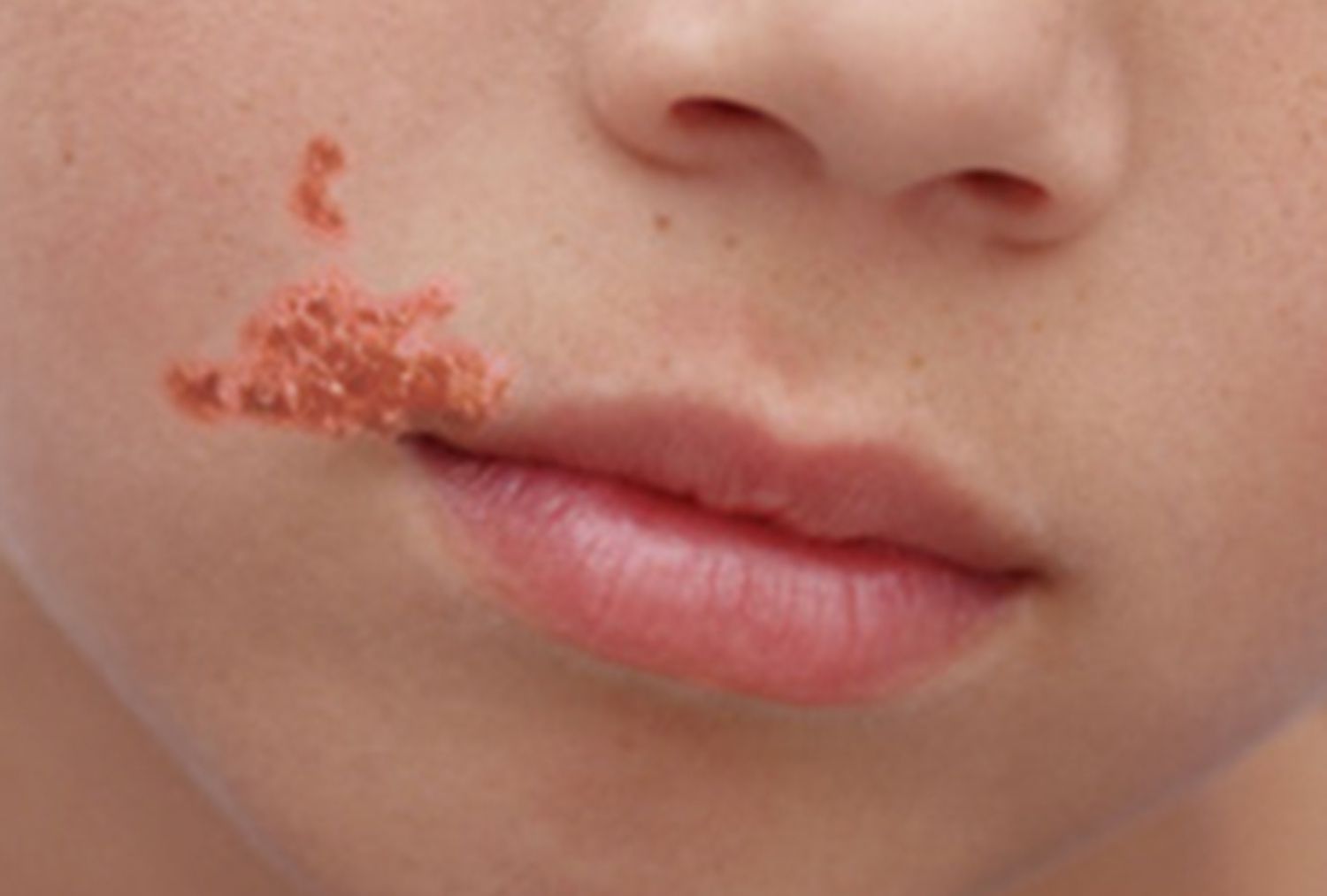 OSC_Microbio_21_02_impetigo-5900cd203df78ca159df4695-da2cc13f23e0432fa28d6de595c221f3