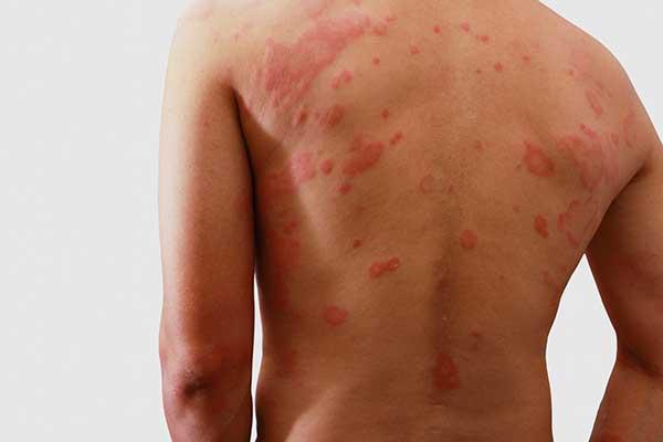 skin-rashes